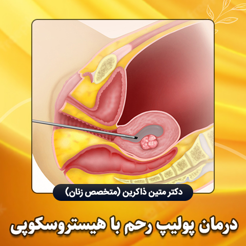 درمان-پولیپ-رحم-با-هیستروسکوپی