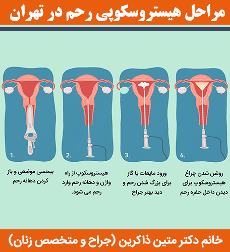 مراحل-هیستروسکوپی-رحم-در-تهران