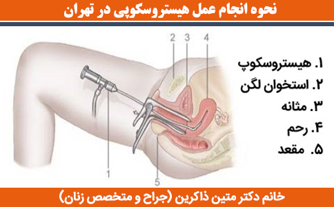 نحوه-انجام-عمل-هیستروسکوپی-در-تهران