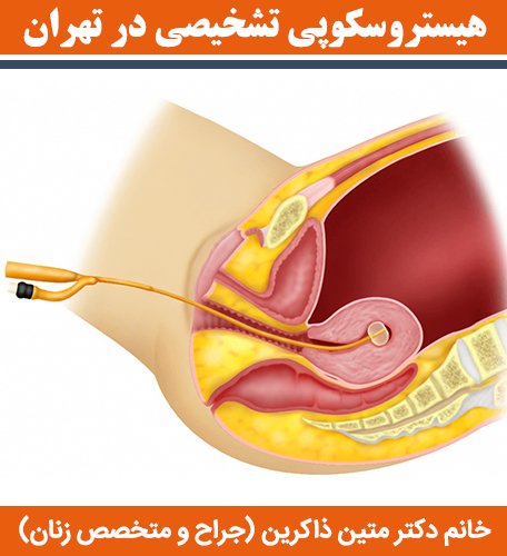 هیستروسکوپی-تشخیصی-در-تهران