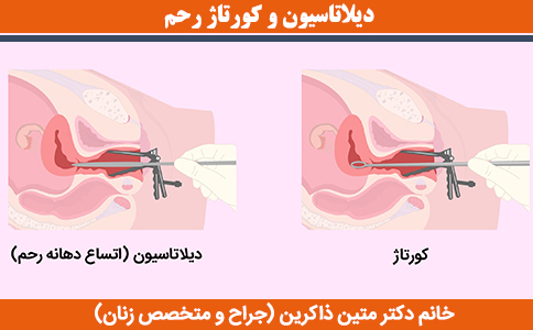 دیلاتاسیون-و-کورتاژ-رحم