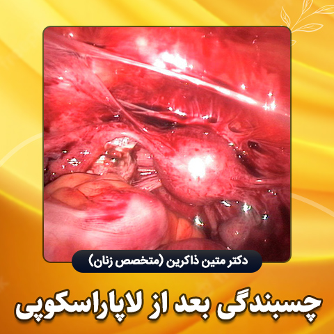 چسبندگی-بعد-از-لاپاراسکوپی